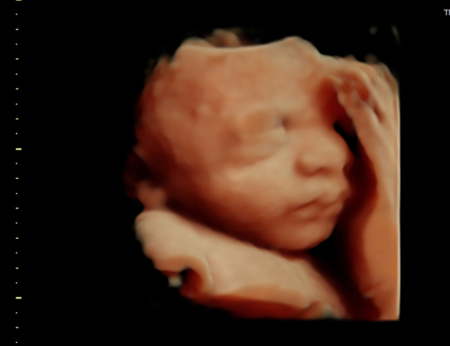 3D ultrasound image at 31 weeks